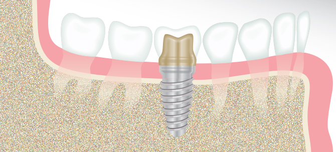 Dental Implant Illustration - Winston-Salem Dentist